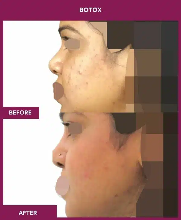 5 Botox (2)