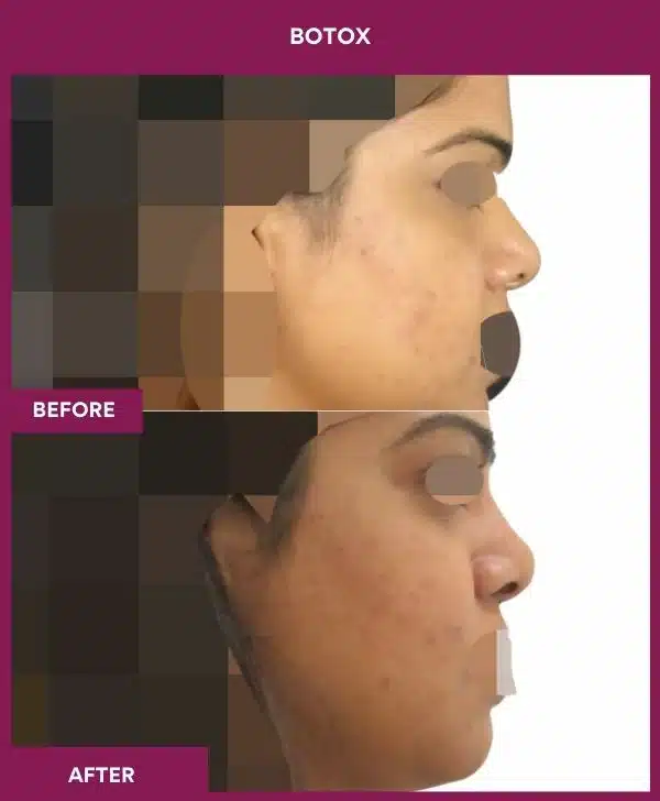 5 Botox (3)