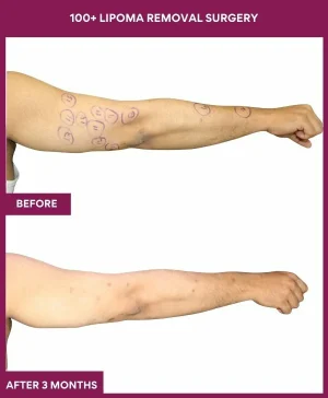 1 100+ Lipoma Removal Surgery