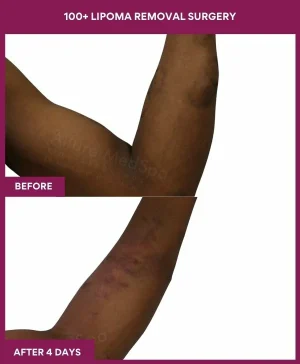 12 100+ Lipoma Removal Surgery (2)