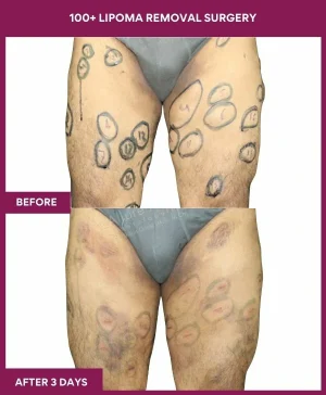 2 100+ Lipoma Removal Surgery