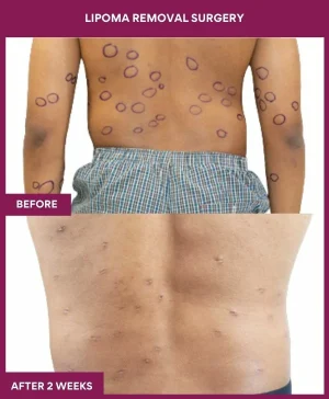 2 Lipoma Removal Surgery (2)