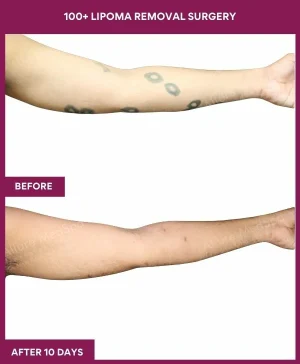3 100+ Lipoma Removal Surgery