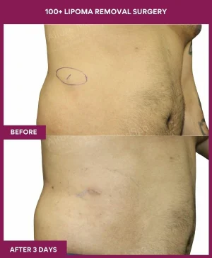 5 100+ Lipoma Removal Surgery