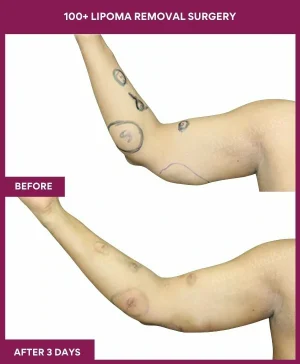 5 100+ Lipoma Removal Surgery