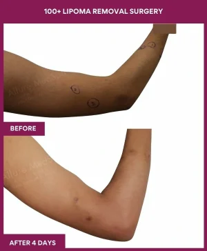 8 100+ Lipoma Removal Surgery