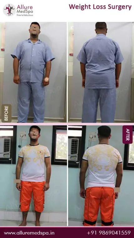 Bariatric-Surgery-Before-and-After-Pictures-in-Mumbai-India