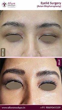 Blepharoplasty-Before-and-After-Photos-in-Mumbai-India