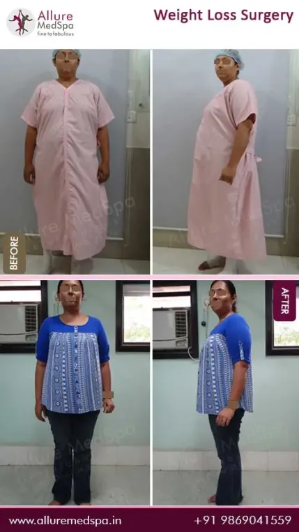 Weight-Loss-Surgery-Before-and-After-Images-in-Mumbai-India