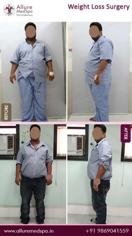 Weight-Loss-Surgery-Before-and-After-Result-in-Mumbai-India