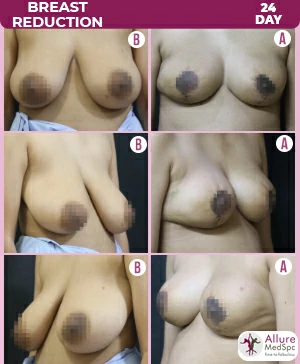 BREAST-REDUCTION