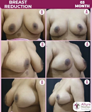 BREAST-REDUCTION-M03