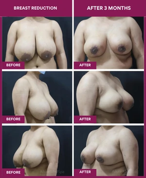 BREAST-REDUCTION-after-3-months