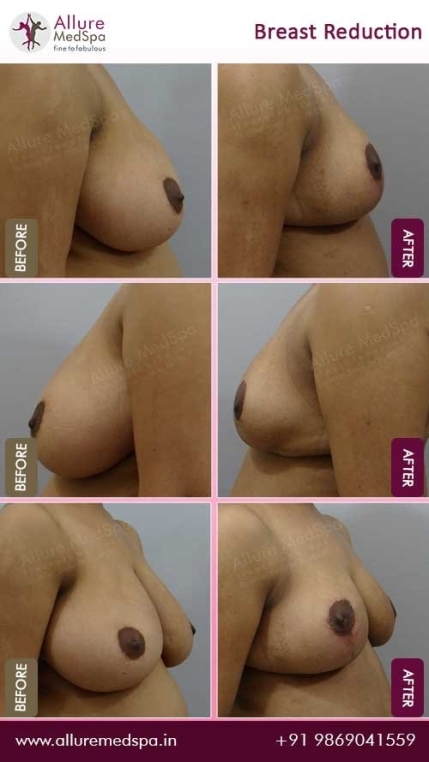 Breast-Reduction-Before-After-Gallery-Mumbai