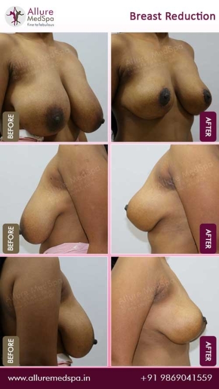 Breast-Reduction-Before-After-Gallery-Mumbai-India