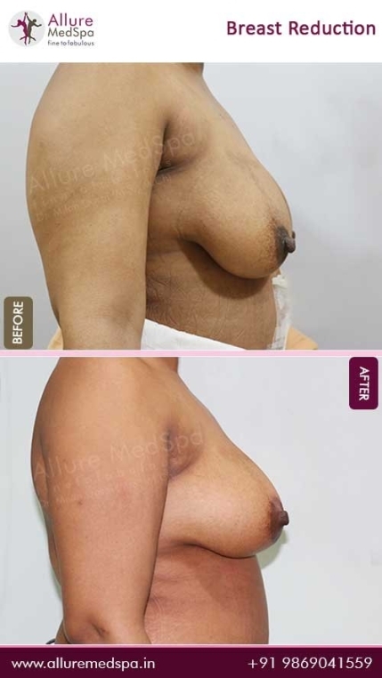 Breast-Reduction-Before-After-Image-Mumbai