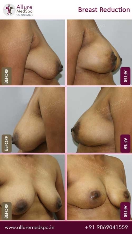 Breast-Reduction-Before-After-Image-Mumbai-India