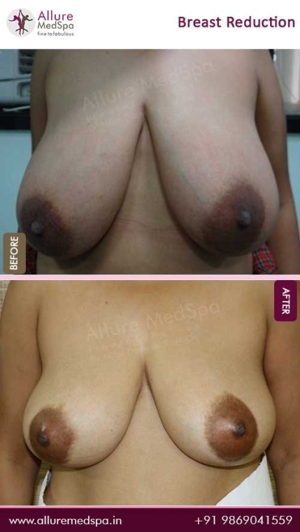 Breast-Reduction-Before-After-Result-Mumbai