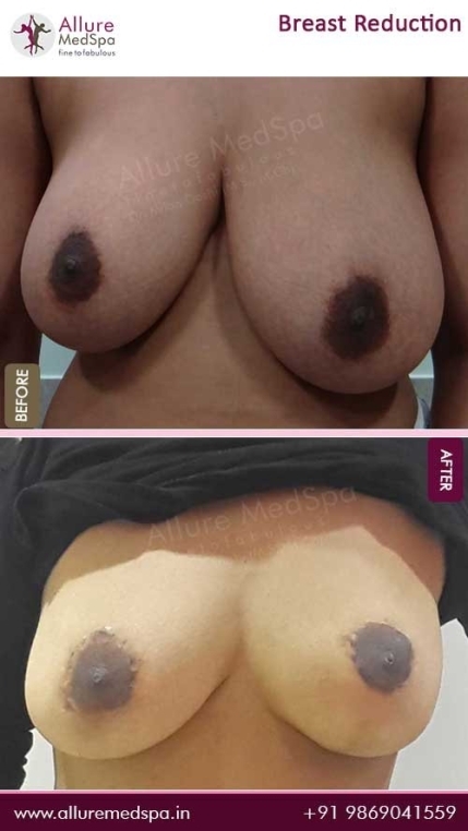 Breast-Reduction-Surgery-Before-After-Gallery-Mumbai
