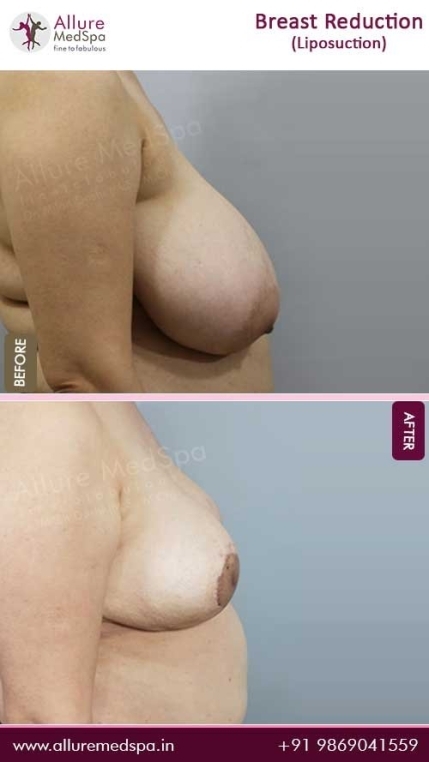Breast-Reduction-With-Liposuction-Before-After-Gallery-Mumbai