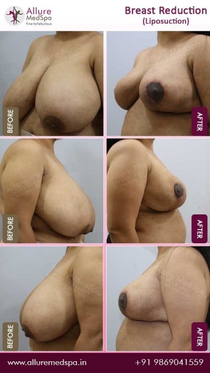 Breast-Reduction-With-Liposuction-Before-After-Gallery-Mumbai-India