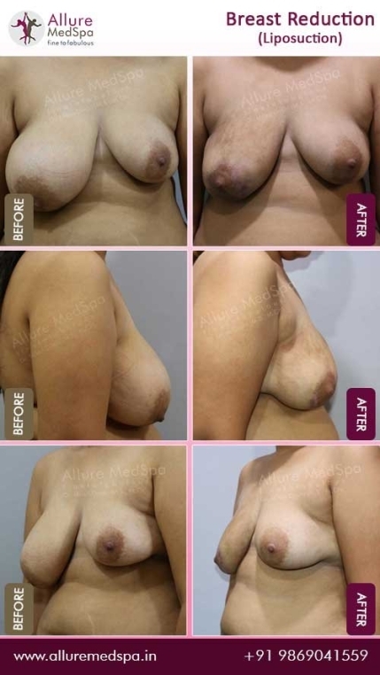 Breast-Reduction-With-Liposuction-Before-After-Photo-Mumbai