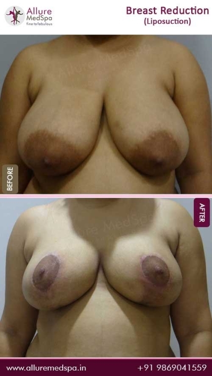 Breast-Reduction-With-Liposuction-Before-After-Photo-Mumbai-India