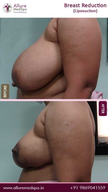 Breast-Reduction-With-Liposuction-Before-After-Pics-Mumbai
