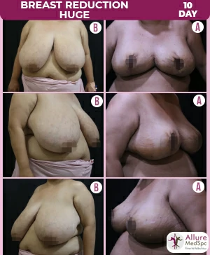 Breast_Reduction_Huge