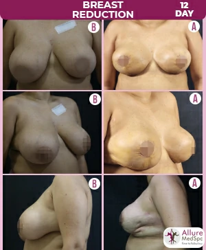 Breast_reduction