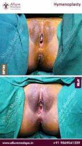 Hymenoplasty Before and After Images