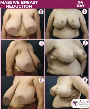 Massive_breast_reduction