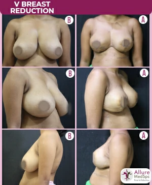 V_breast_reduction