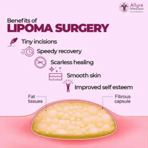 Benefits of Lipoma Surgery in Mumbai, India