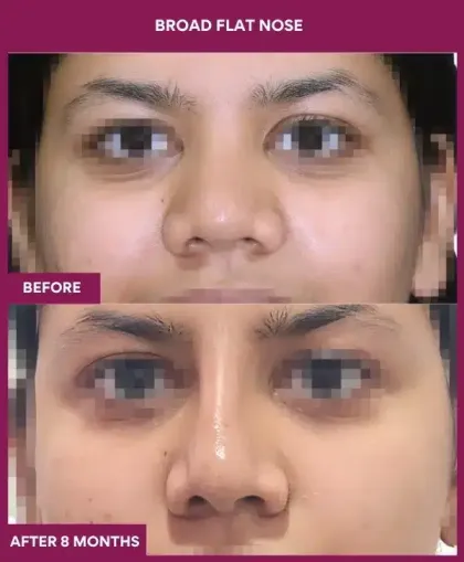 Broad Flat Nose Before After Result