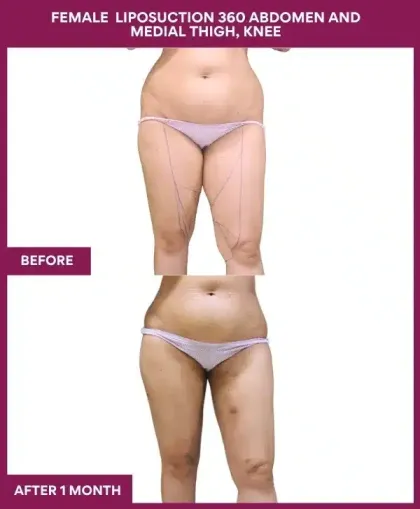 Female Thigh Liposuction Before After Images in Mumbai, India