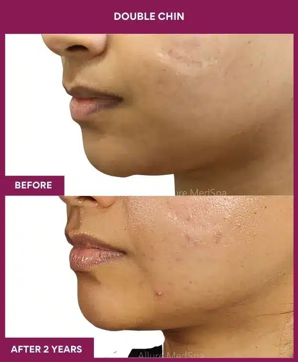 1 Double Chin (2)_49