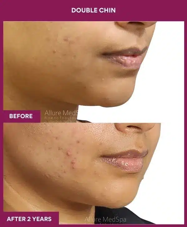 1 Double Chin (4)_49