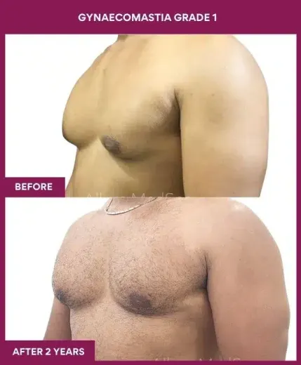 1- GYNAECOMASTIA GRADE 1 (2)_