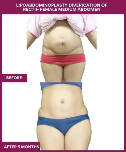 1 LIPOABDOMINOPLASTY DIVERICATION OF RECTII- FEMALE MEDIUM ABDOMEN_3_ (1)
