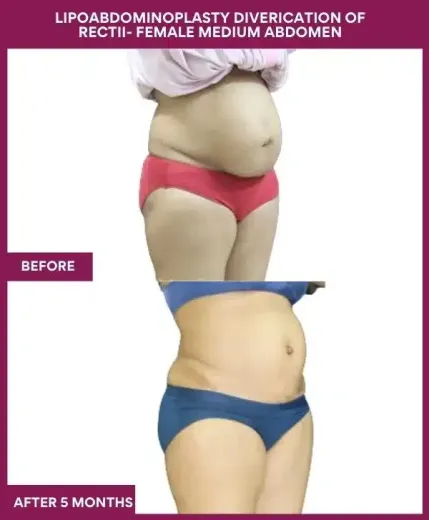 1 LIPOABDOMINOPLASTY DIVERICATION OF RECTII- FEMALE MEDIUM ABDOMEN_3_ (2)