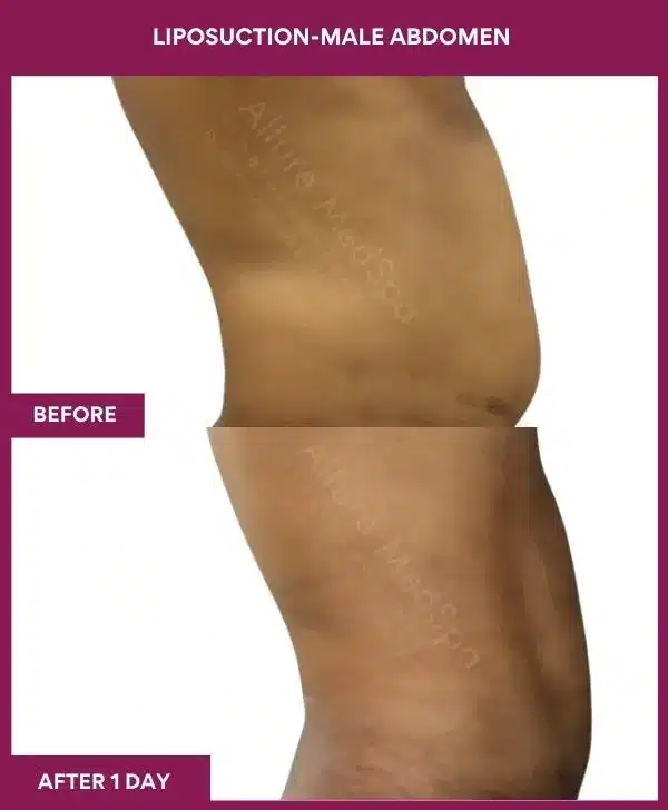 1 LIPOSUCTION-MALE ABDOMEN (2)