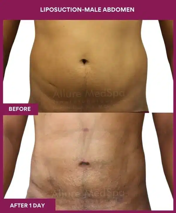 1 LIPOSUCTION-MALE ABDOMEN (4)