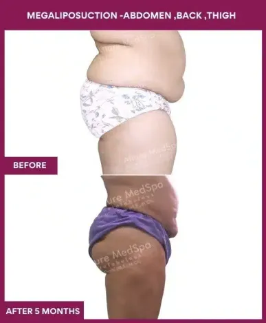 1- MEGALIPOSUCTION -ABDOMEN ,BACK ,THIGH