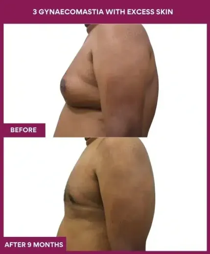 10- 3 gynaecomastia with excess skin (2)_