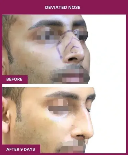 10 deviated nose_36 in Mumbai, India