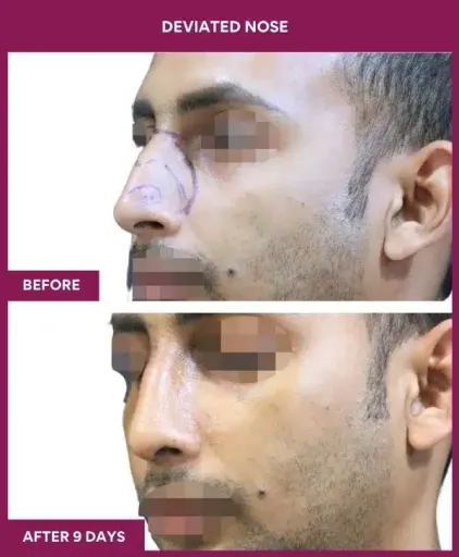 10 deviated nose_36 in Mumbai, India