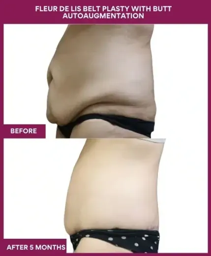 11 Fleur de lis Belt plasty with butt autoaugmentation_ (5)