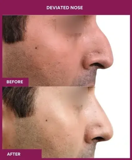 11 deviated nose_37 in Mumbai, India