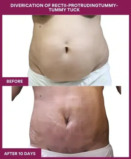 12 DIVERICATION OF RECTII-PROTRUDINGTUMMY- TUMMY TUCK (4)_7_